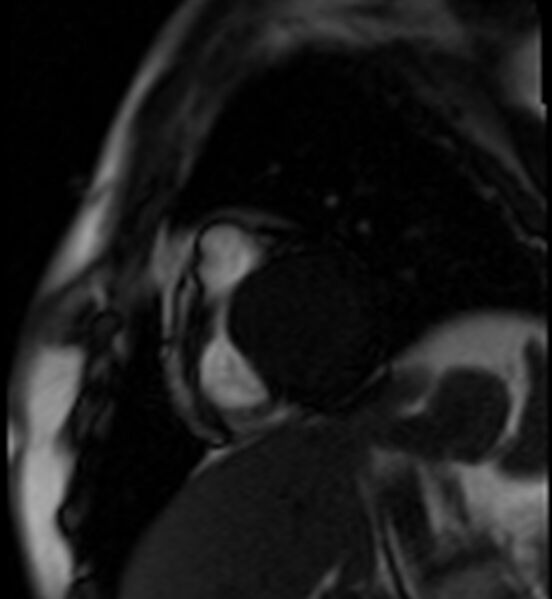 File:Acute anteroseptal myocardial infarction (Radiopaedia 68409-77945 Short axis (basal) Perfusion 4).jpg