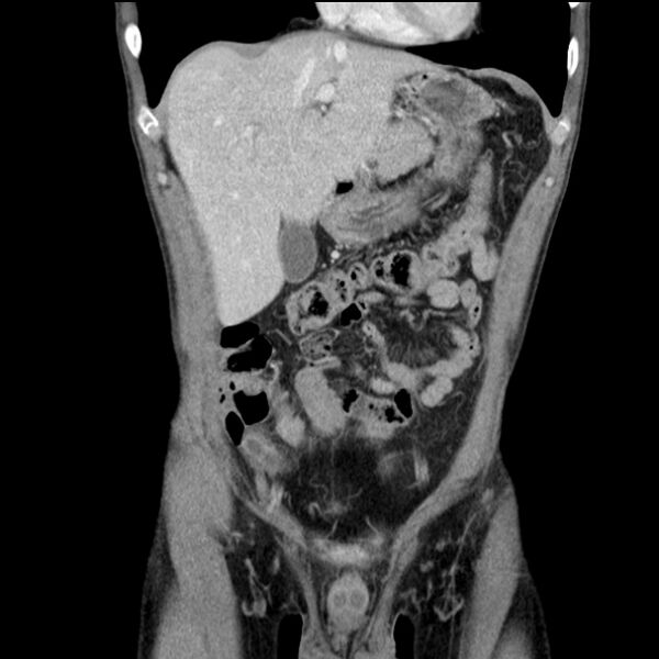 File:Acute appendicitis (Radiopaedia 27049-27227 Coronal C+ portal venous phase 16).jpg