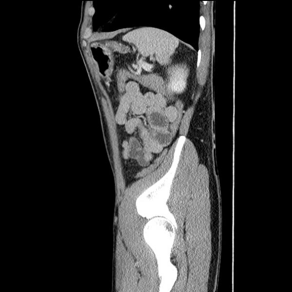 File:Acute appendicitis (Radiopaedia 27049-27227 Sagittal C+ portal venous phase 66).jpg