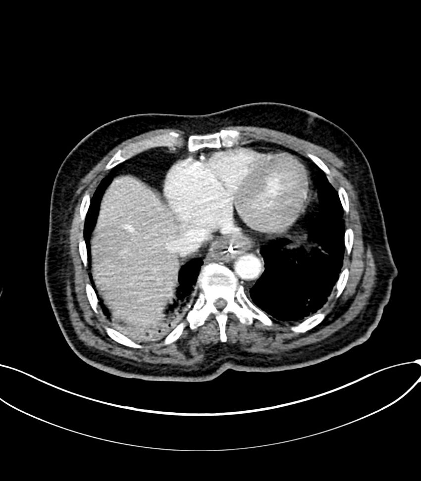 Acute arterial mesenteric ischemia (Radiopaedia 78238-90828 Axial C+ portal venous phase 17).jpg