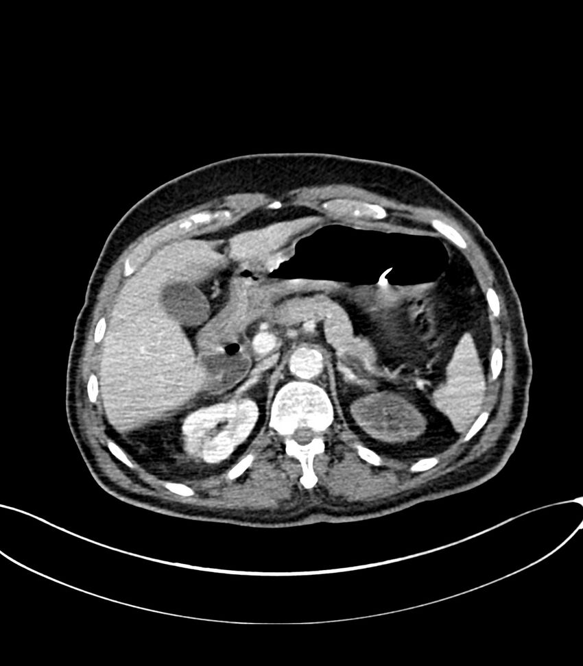 Acute arterial mesenteric ischemia (Radiopaedia 78238-90828 Axial C+ portal venous phase 41).jpg