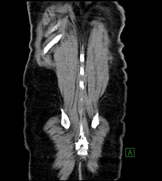 File:Acute arterial mesenteric ischemia (Radiopaedia 78238-90828 Coronal C+ portal venous phase 83).jpg
