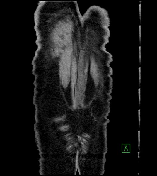 File:Acute arterial mesenteric ischemia (Radiopaedia 78238-90828 Coronal C+ portal venous phase 87).jpg
