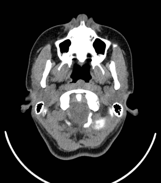 File:Acute bacterial tonsillitis (Radiopaedia 22882-22908 Axial non-contrast 8).png