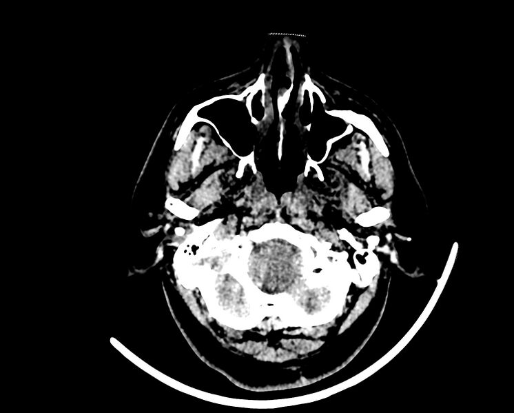 File:Acute cerebral infarct (Radiopaedia 35604-37123 Axial non-contrast 9).jpg