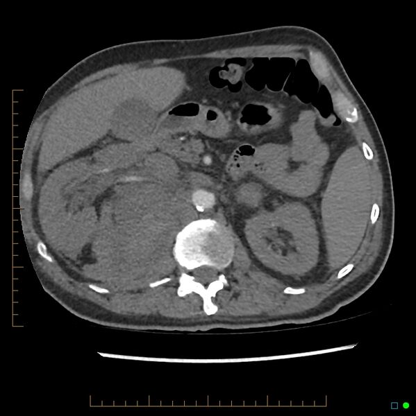 File:Acute hemorrhage into adrenal metastasis from NSCLC (Radiopaedia 43135-46429 Axial C+ CTPA 18).jpg