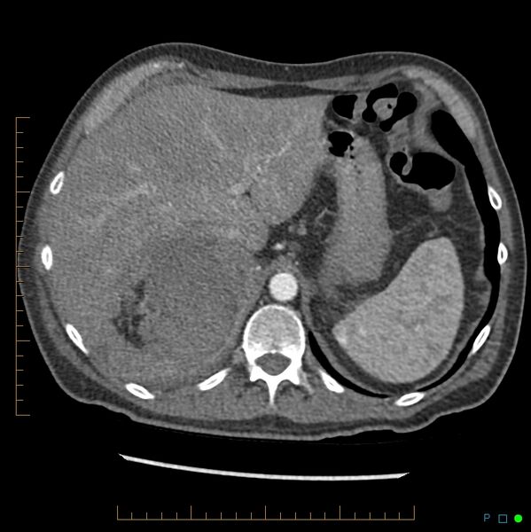 File:Acute hemorrhage into adrenal metastasis from NSCLC (Radiopaedia 43135-46429 Axial C+ arterial phase 6).jpg