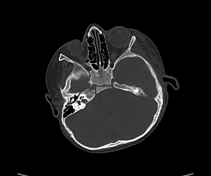 File:Acute hemorrhagic contusion (Radiopaedia 63660-72336 Axial bone window 18).jpg