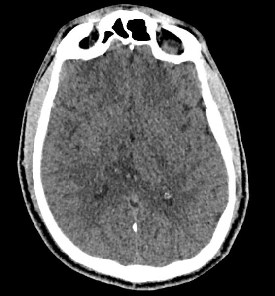File:Acute ischemic stroke - posterior circulation territory (Radiopaedia 77670-89881 non-contrast 45).jpg