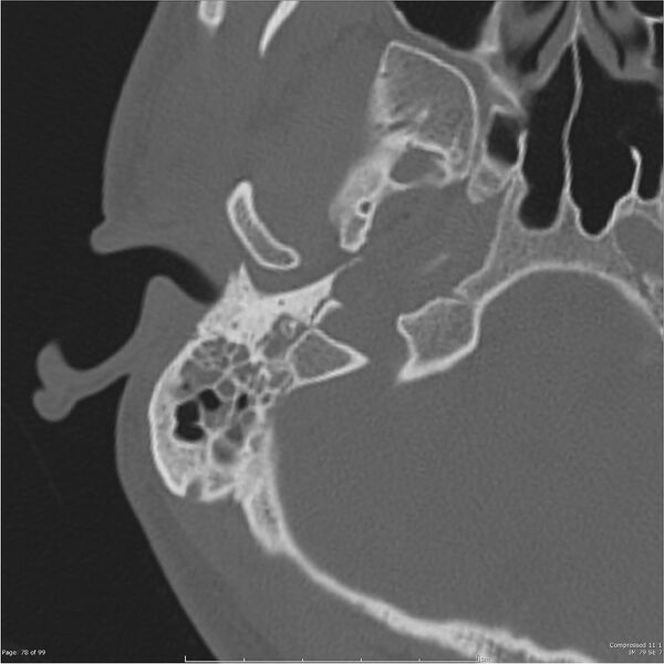 File:Acute otomastoiditis (Radiopaedia 28276-28512 Axial PTB bone window reformat 58).jpg