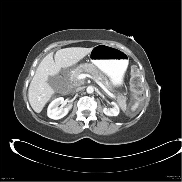 File:Acute pancreatitis (Radiopaedia 19136-19117 Axial C+ portal venous phase 12).jpg