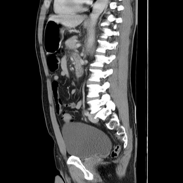 File:Acute pancreatitis (Radiopaedia 22572-22596 Sagittal C+ portal venous phase 32).jpg