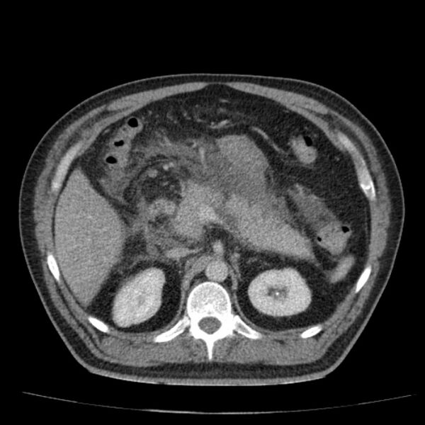 File:Acute pancreatitis (Radiopaedia 26663-26813 Axial C+ portal venous phase 28).jpg