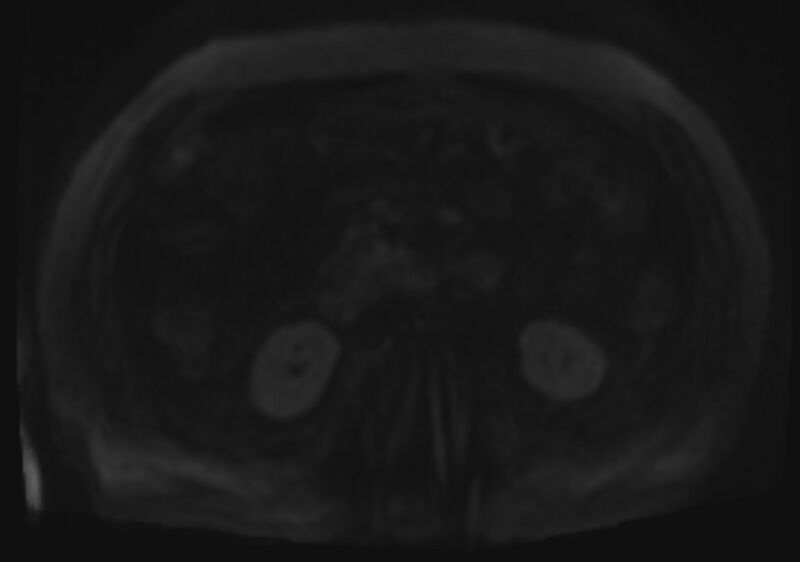 File:Acute portal vein thrombosis (Radiopaedia 73198-83925 Axial DWI 83).jpg