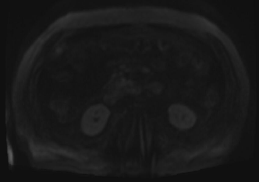 Acute portal vein thrombosis (Radiopaedia 73198-83925 Axial DWI 83).jpg