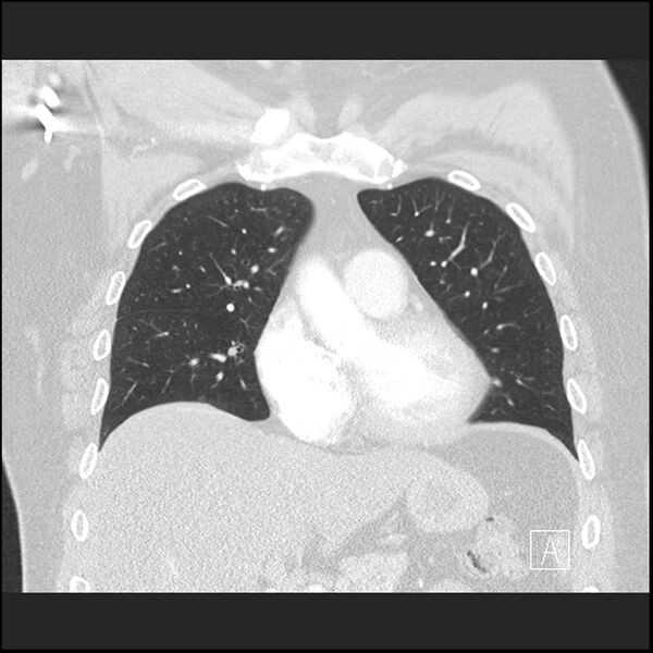 File:Acute pulmonary embolism with pulmonary infarct (Radiopaedia 73062-83768 Coronal lung window 27).jpg