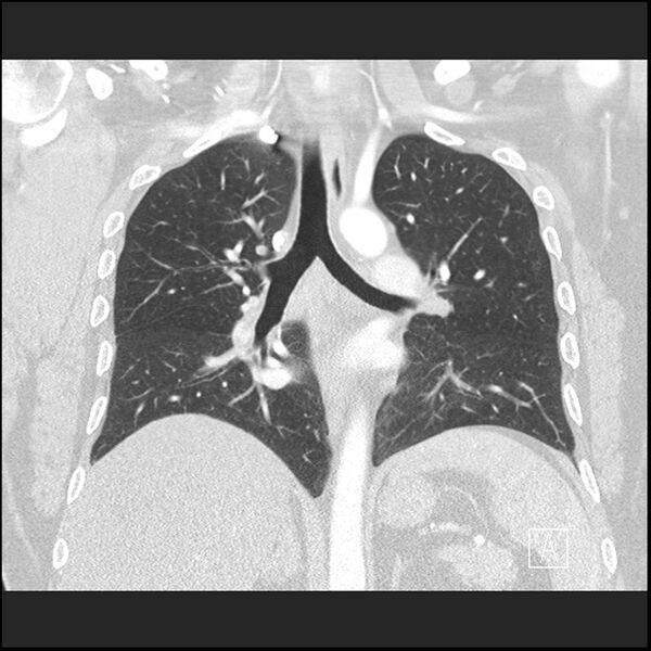 File:Acute pulmonary embolism with pulmonary infarct (Radiopaedia 73062-83768 Coronal lung window 44).jpg