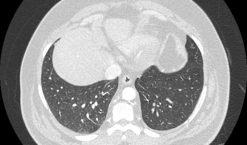 Acute pulmonary embolism with pulmonary infarcts (Radiopaedia 77688-89908 Axial lung window 100).jpg