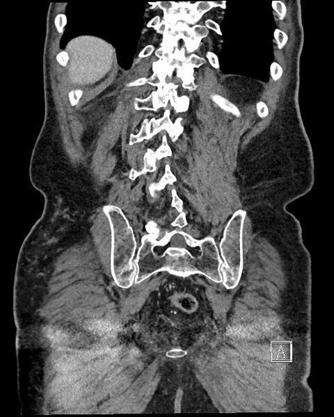 File:Acute renal infarction - rim capsular enhancement (Radiopaedia 59833-67270 Coronal C+ portal venous phase 56).jpg