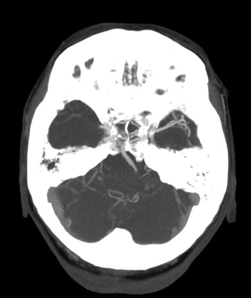 File:Acute right MCA M1 occlusion (Radiopaedia 62268-70454 Axial Phase 1 22).jpg