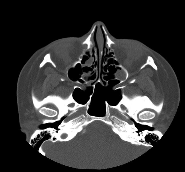 File:Acute sinusitis (Radiopaedia 22419-22455 Axial non-contrast 16).jpg