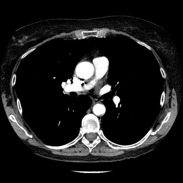 File:Adenocarcinoma of the lung (Radiopaedia 41015-43755 Axial C+ portal venous phase 57).jpg