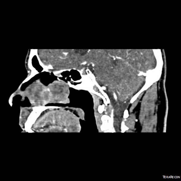 File:Adenoid cystic carcinoma involving paranasal sinus (Radiopaedia 16580-16283 Sagittal C+ arterial phase 4).jpeg
