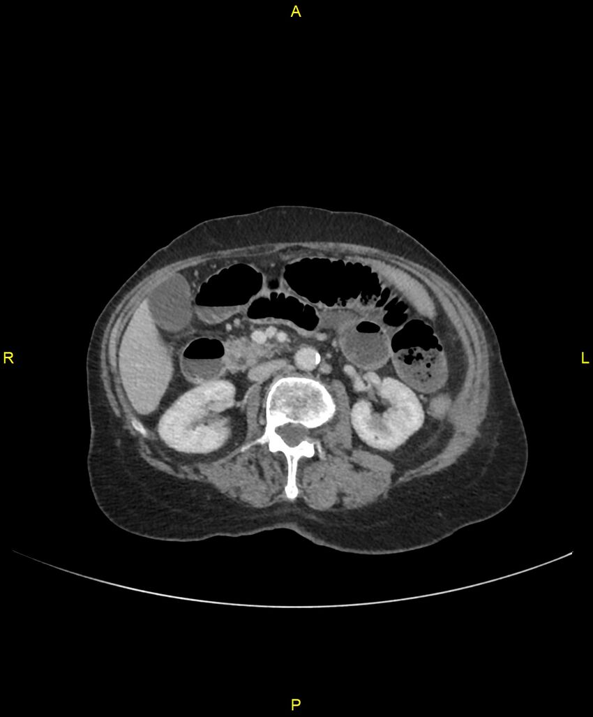 Adhesional small bowel obstruction (Radiopaedia 85402-101024 Axial C+ portal venous phase 118).jpg
