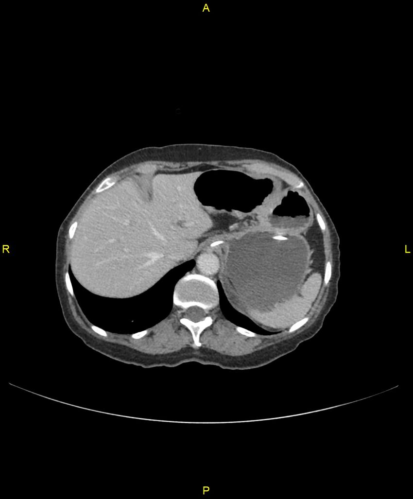 Adhesional small bowel obstruction (Radiopaedia 85402-101024 Axial C+ portal venous phase 52).jpg