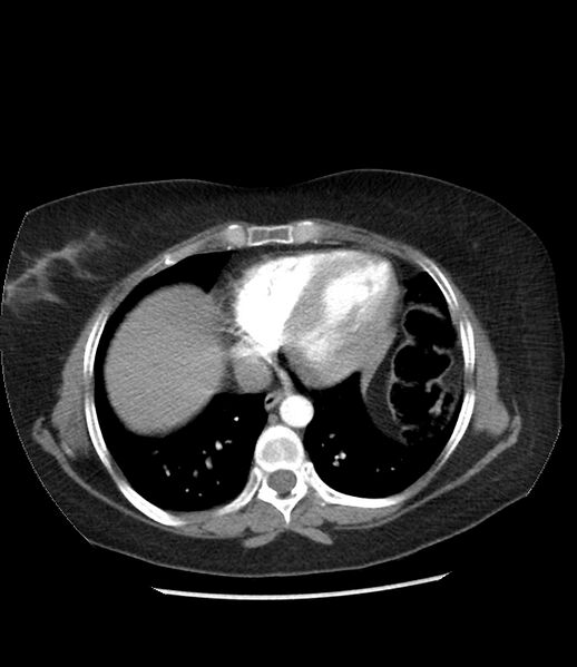 File:Adrenal cortical carcinoma with IVC invasion and thrombosis (Radiopaedia 34307-35597 Axial C+ arterial phase 6).jpg