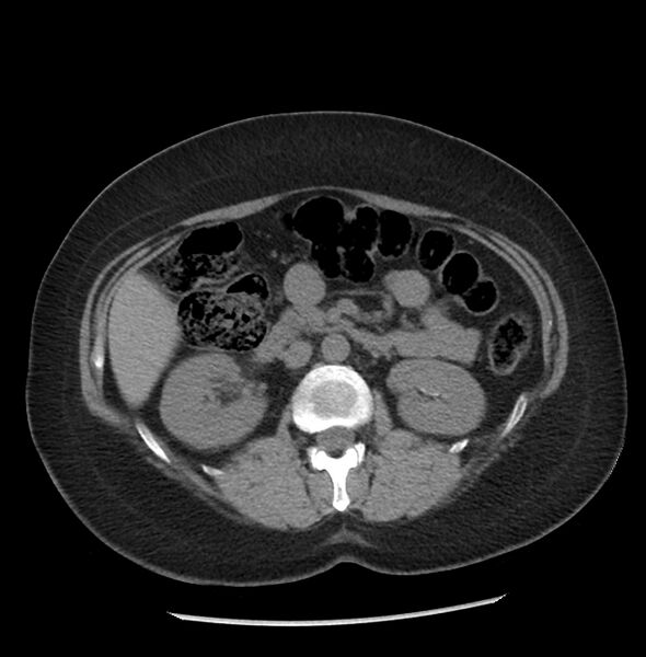 File:Adrenal cortical carcinoma with IVC invasion and thrombosis (Radiopaedia 34307-35597 Axial non-contrast 26).jpg