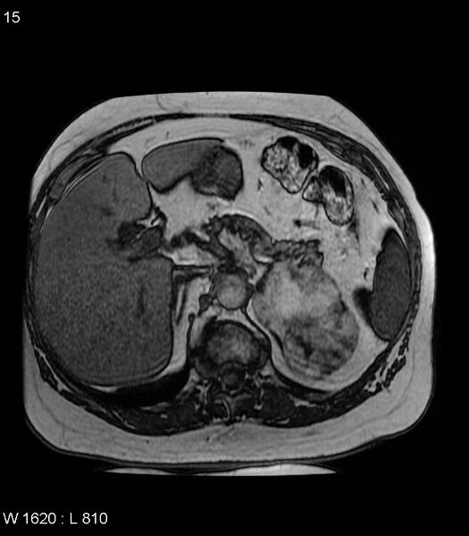 File:Adrenal myelolipoma (Radiopaedia 6765-7961 Axial T1 out-of-phase 15).jpg