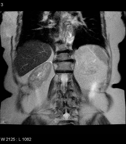 File:Adrenal myelolipoma (Radiopaedia 6765-7961 Coronal T2 3).jpg