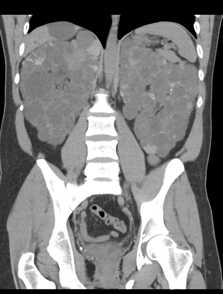 File:Adult polycystic kidney disease (Radiopaedia 47866-52626 Coronal non-contrast 31).png