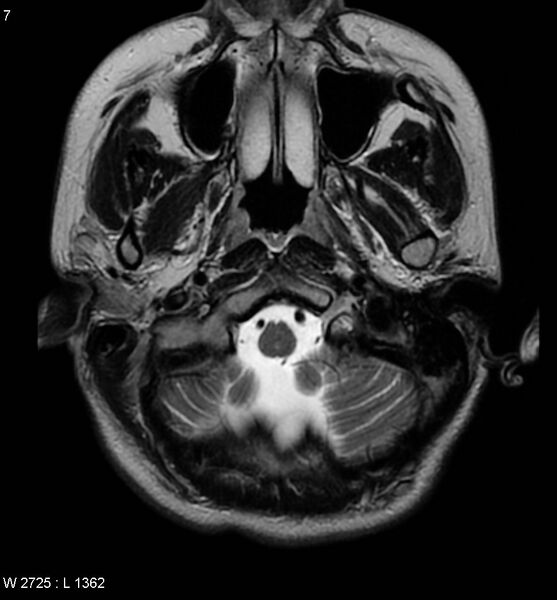 File:Aicardi syndrome (Radiopaedia 5353-7117 Axial T2 2).jpg