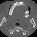 Ameloblastic fibro-odontoma (Radiopaedia 18843-18780 C 49).jpg
