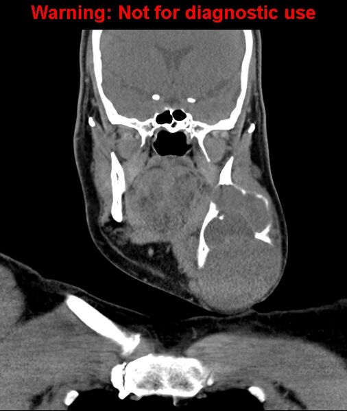File:Ameloblastoma (Radiopaedia 33126-34164 D 33).jpg