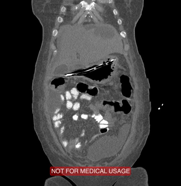 File:Amoebic enterocolitis with liver abscess (Radiopaedia 35100-36609 B 24).jpg