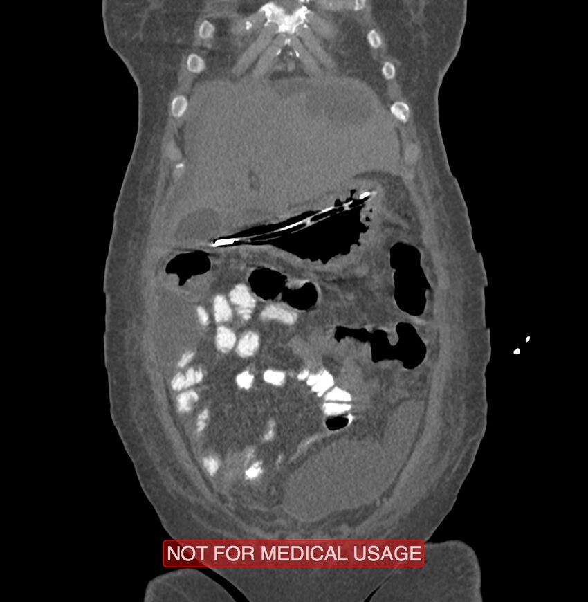 Amoebic enterocolitis with liver abscess (Radiopaedia 35100-36609 B 24).jpg