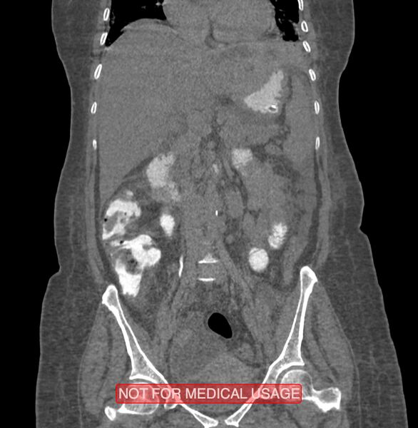 File:Amoebic enterocolitis with liver abscess (Radiopaedia 35100-36609 B 96).jpg