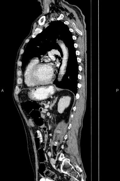 File:Ampullary adenocarcinoma (Radiopaedia 86093-102033 E 60).jpg