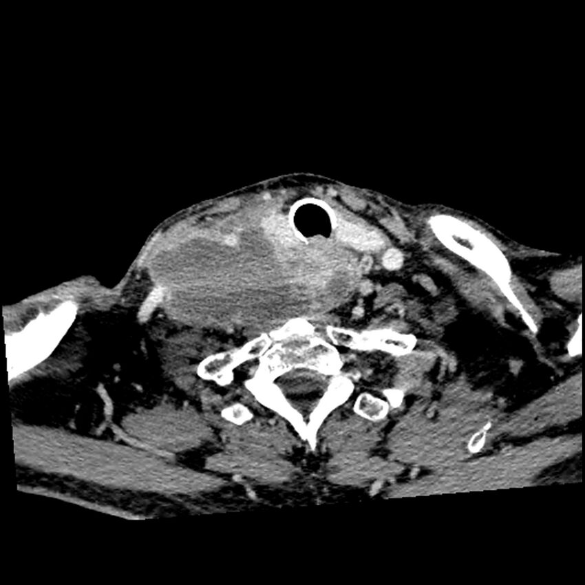 Anaplastic thyroid carcinoma (Radiopaedia 79087-92034 B 40).jpg