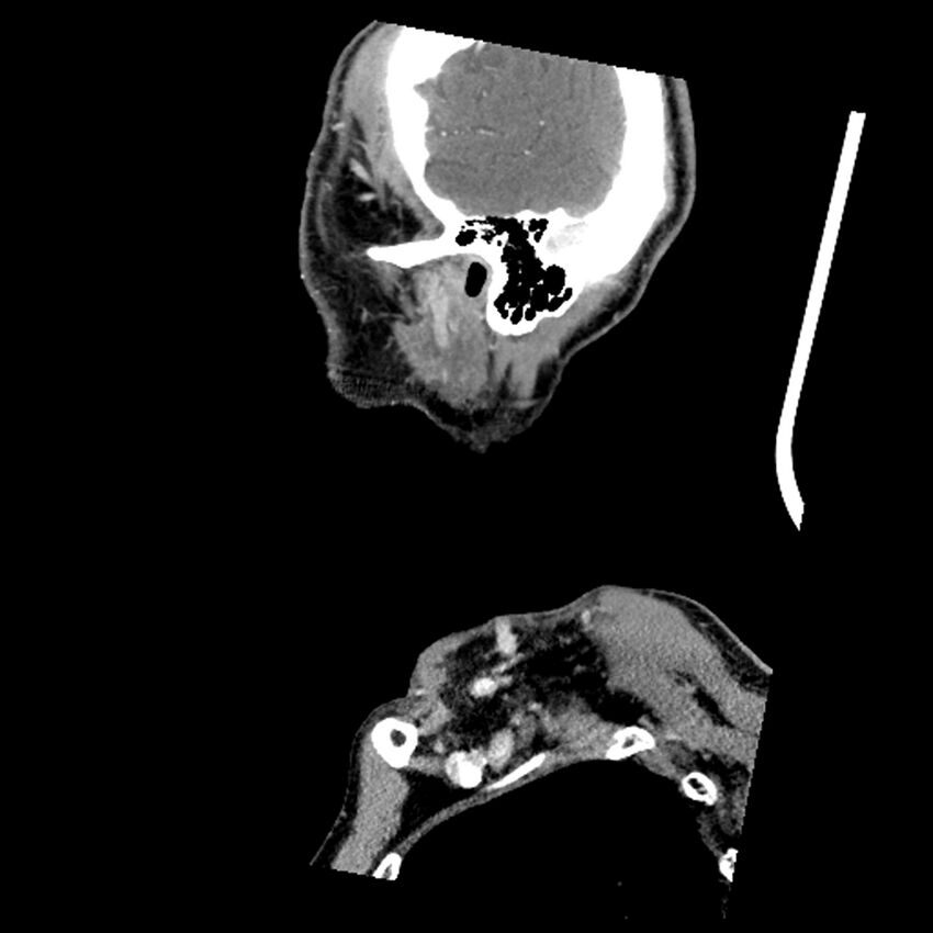 Anaplastic thyroid carcinoma (Radiopaedia 79087-92034 C 15).jpg