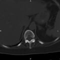 Ankylosing spondylitis (Radiopaedia 8748-9556 Axial bone window 12).jpg
