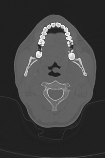 File:Anterior nasal spine fracture (Radiopaedia 46138-50494 Axial bone window 63).png