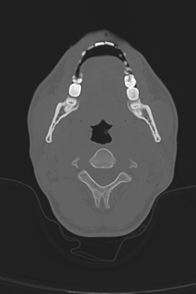 File:Anterior nasal spine fracture (Radiopaedia 46138-50494 Axial bone window 65).png