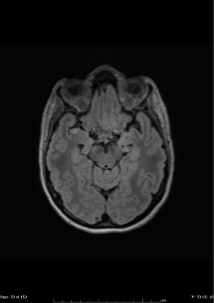 File:Anterior temporal lobe perivascular space (Radiopaedia 40946-43650 Axial FLAIR 14).jpg
