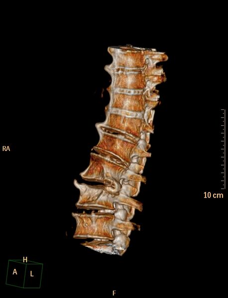 File:Anterior vertebral scalloping (abdominal aortic aneurysm) (Radiopaedia 66744-76067 A 3).jpg