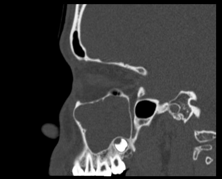 File:Antrochoanal polyp (Radiopaedia 21894-21868 Sagittal bone window 11).jpg
