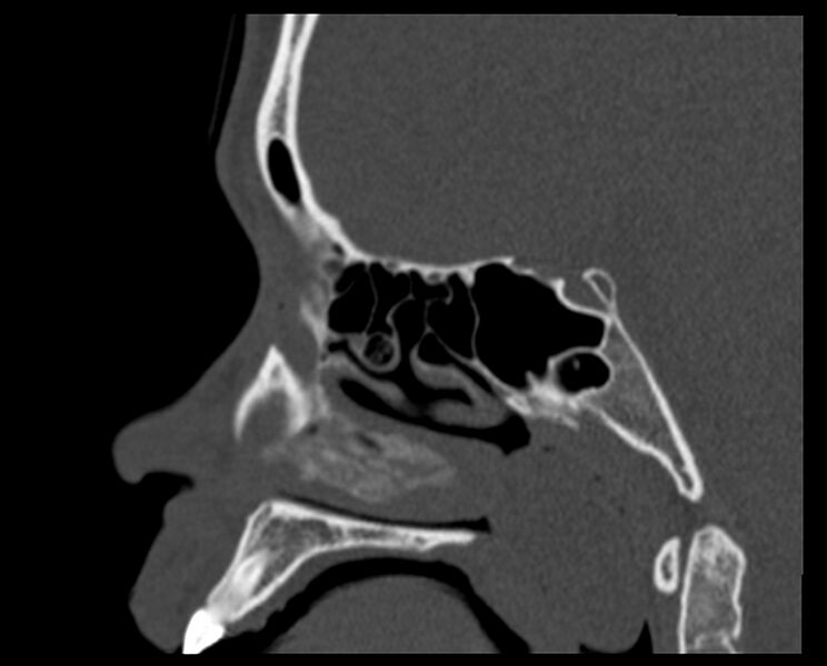 File:Antrochoanal polyp (Radiopaedia 21894-21868 Sagittal bone window 24).jpg